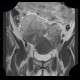 Mixed adenoneuroendocrine tumour of appendix, mixed tumour, hydronephrosis, ascites: MRI - Magnetic Resonance Imaging